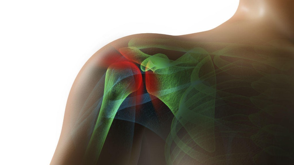 Rotator Cuff Tear Lawyer - Missouri Workers Comp Attorneys