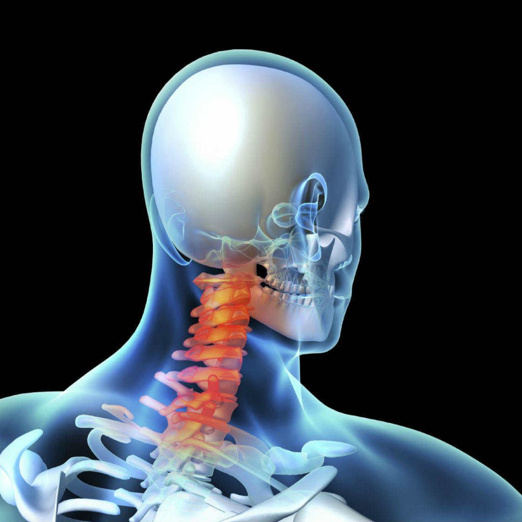 Cervical Disc Replacement Lawyer