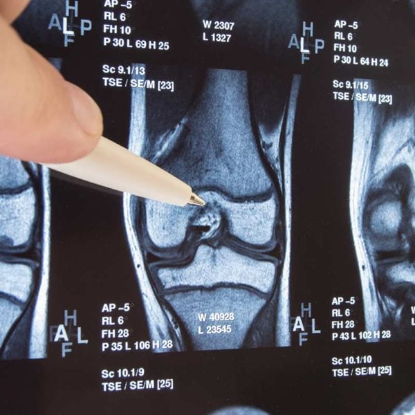 What Is Occupational Osteoarthritis?